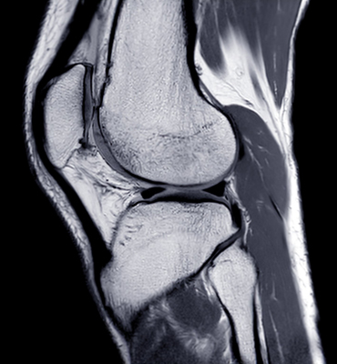 Tendinopathies