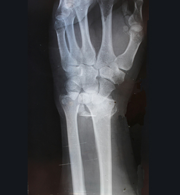 Osteoarthritis